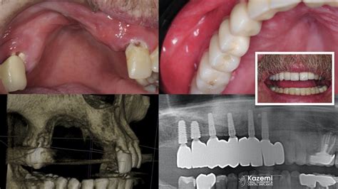 Teeth model Enlarged version Oral pathology model of dental dental disease implant restoration ...