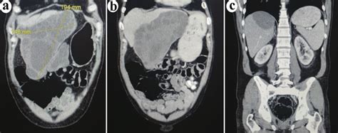 Coronal images of the computed tomodensitometry scan performed at... | Download Scientific Diagram