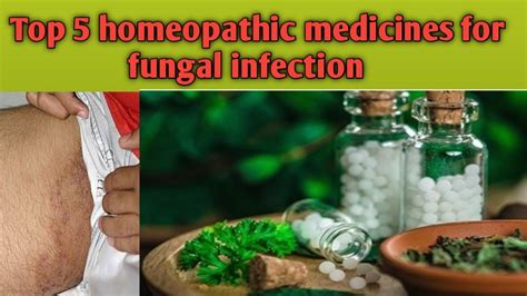 5 best homeopathic medicines for fungal infection/homeopathic treatment ...