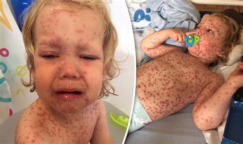 Toddler with worst chickenpox doctors had ever seen was turned down for ...