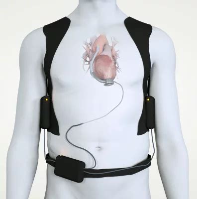 LVAD - Left Ventricular Assist Device | Colorado | UCHealth