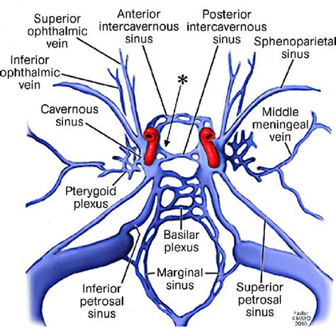 (PDF) Intercavernous Sinus Dural Arteriovenous Fistula Successfully ...