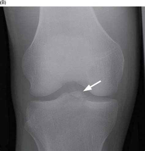 Anterior Tibial Spine