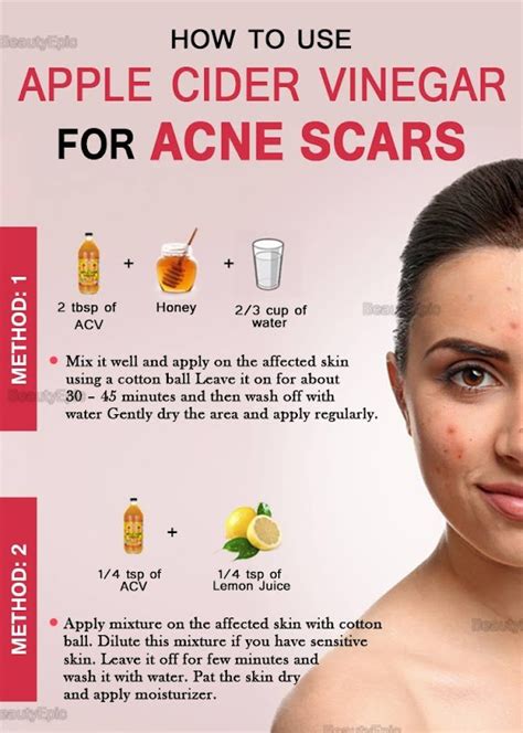 Benefits of Using Apple Cider Vinegar For Acne