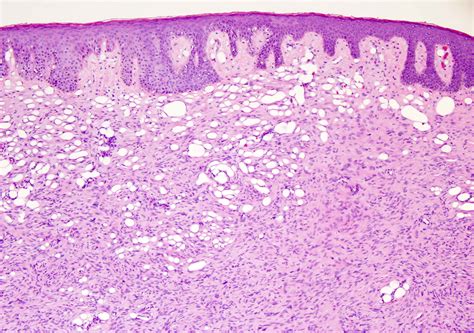 Dermatofibrosarcoma Protuberans | Dermatopathology