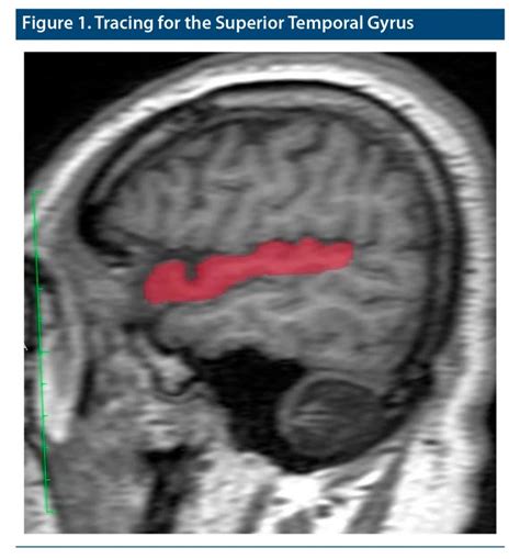 Superior Temporal Gyrus Volumes in Patients With Social Anxiety ...