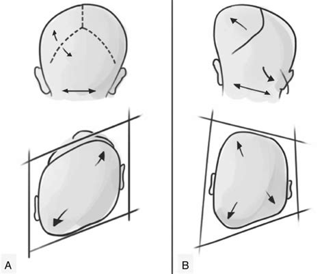 Plagiocephaly causes, symptoms, diagnosis & treatment