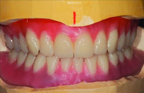 Completed maxillary and mandibular denture tooth setup. Figure ...