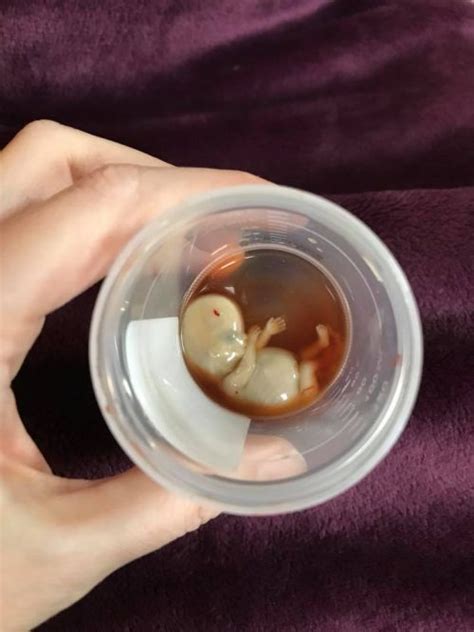 Mother shares incredible photo of baby miscarried at 11 weeks