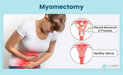 Myomectomy: Procedure, Indications, Steps, Recovery Time