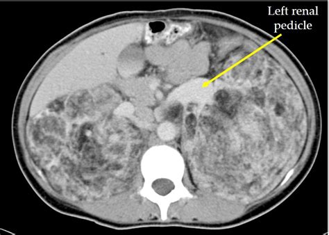 Renal angiomyolipoma – Radiology Cases