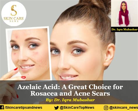 Azelaic Acid: A Great Choice for Rosacea and Acne Scars