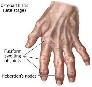 Jammed or Broken Finger Help: Finger Arthritis