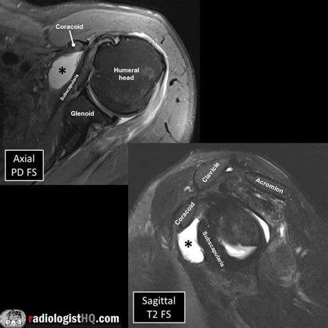 Subdeltoid Bursitis Mri