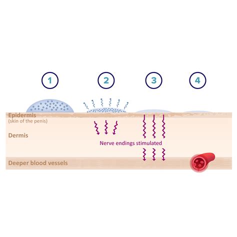 How Eroxon® works - Eroxon