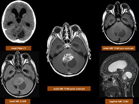 Posterior fossa tumors: clues to differential diagnosis with case-based ...