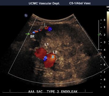 Velocities of type II endoleaks on Doppler ultrasonography predict ...