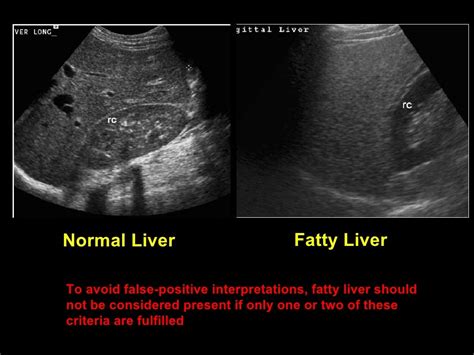 Fatty Liver And Pitfall