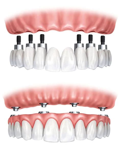 Full Mouth Dental Implants Cost in Palos Verdes and South Bay, California