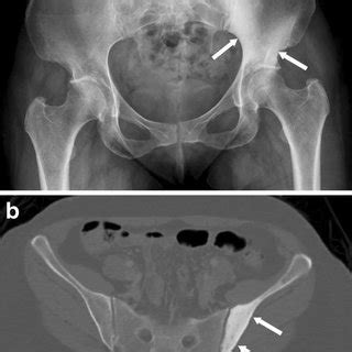 (PDF) Imaging findings in 22 cases of Schnitzler syndrome ...