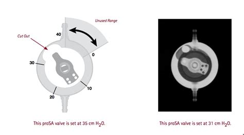 Determining Settings of Programmable VP Shunts | UW Emergency Radiology