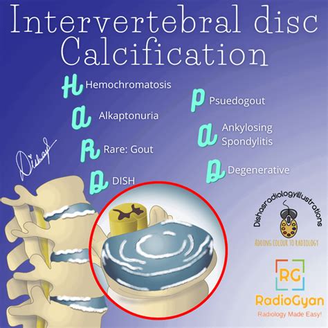 Causes Of Intervertebral Disc Calcification - Visual Mnemonics - RadioGyan