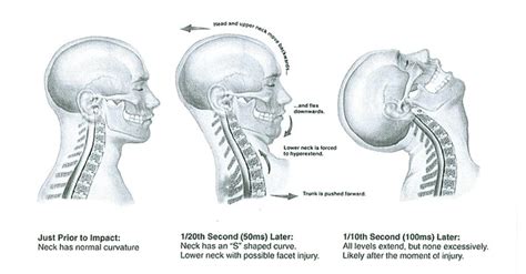 Whiplash Injury and Treatment - Core Healthcare