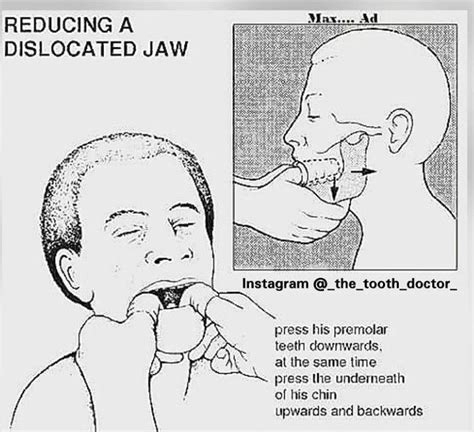 Reducing a dislocated jaw - MEDizzy