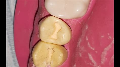 Class I Cavity Preparation For Maxillary First Premolar "U4" - YouTube