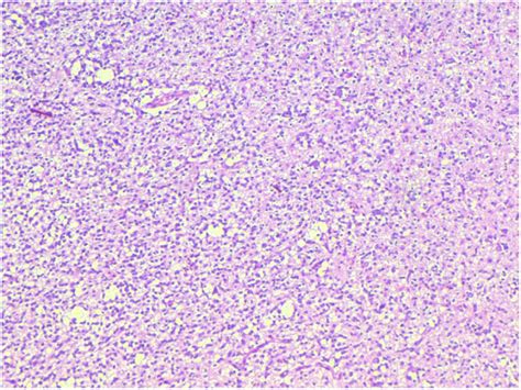 Anaplastic Oligodendroglioma, WHO grade III, showing greater nuclear... | Download Scientific ...