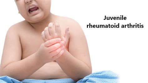 Juvenile Rheumatoid Arthritis Treatment Cost In India - Medsurge India