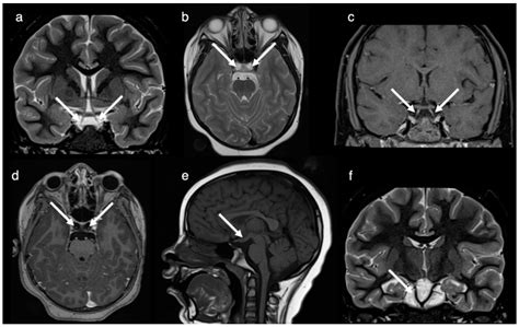 Pituitary Tumor Mri