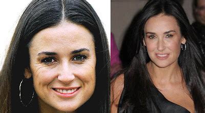 Anti Aging Treatments: Demi Moore Plastic Surgery