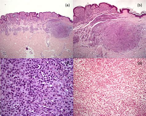 Histological findings. (a) Junctional and dermal melanocytic congenital... | Download Scientific ...