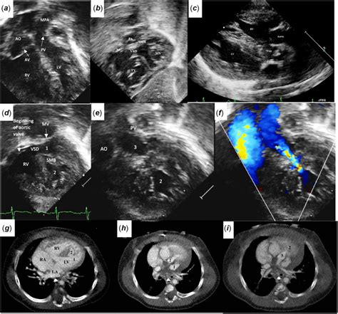 Two-dimensional echocardiogram and color Doppler views (a-f) showing... | Download Scientific ...