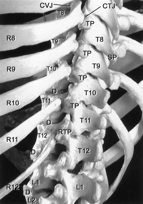 Lateral transthoracic discectomy of T9-10 HNP - cns.org