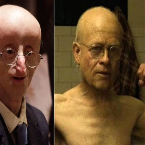 Benjamin Button Syndrome - Francine