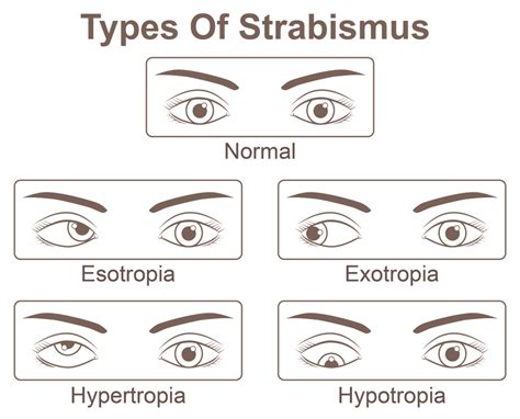 Amblyopia Guide: Causes, Treatment & More | NVISION Eye Centers