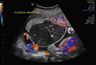 Chorioangioma | Radiology Key