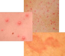 dermatographism treatment - pictures, photos