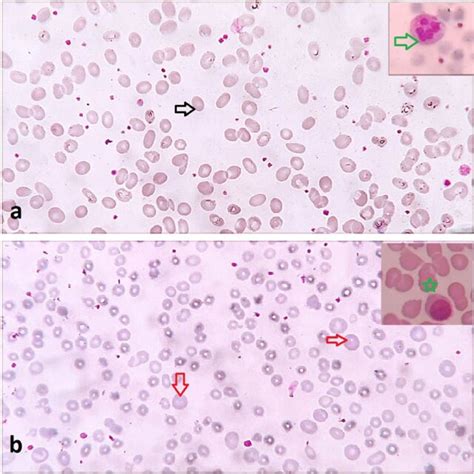 a Peripheral smear in case 1 showing macro-ovalocytes (black arrow) and... | Download Scientific ...