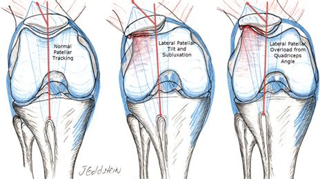 Patellar Chondromalacia – Sports Medicine and Orthopedics