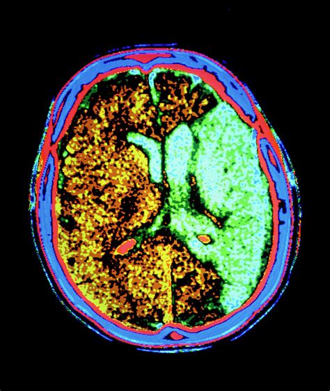 Ct Scan Of Brain With Cerebral Infarction Photograph by Gca/science Photo Library
