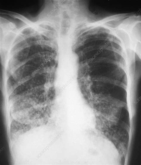 Tuberculosis, X-ray - Stock Image - M270/0255 - Science Photo Library