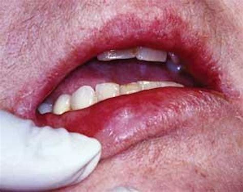 Lichen planus of the lip | Registered Dental Hygenist (RDH) Magazine