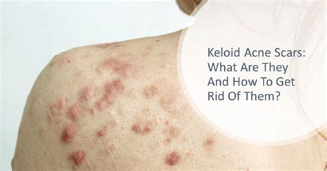 Keloid Acne Scars: What Are They And How To Get Rid of Them? | Dream ...