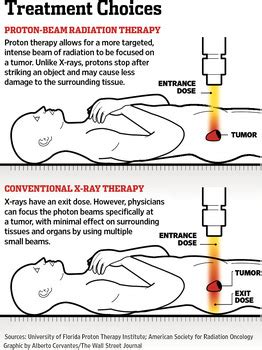 Proton Beam Therapy Prostate Cancer | COMPLICATIONS OF PROSTATE CANCERS: Proton Beam Therapy ...