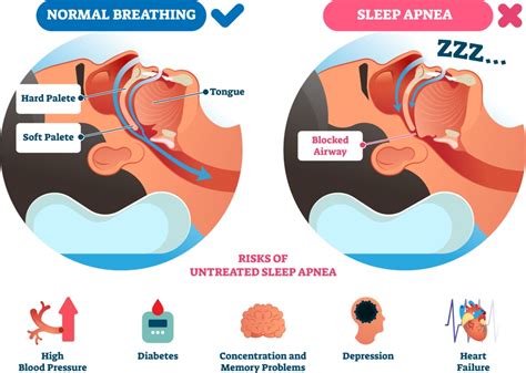 Sleep Apnea ⋆ Belpre Dental Studio®