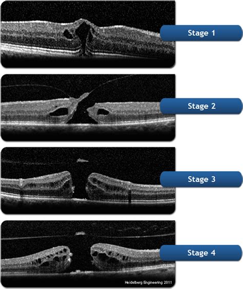 Understand the symptoms, causes, treatment of a Macular Hole