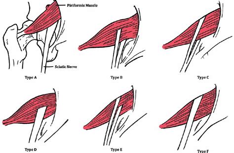 Piriformis syndrome causes, symptoms, test, diagnosis, treatment & stretch